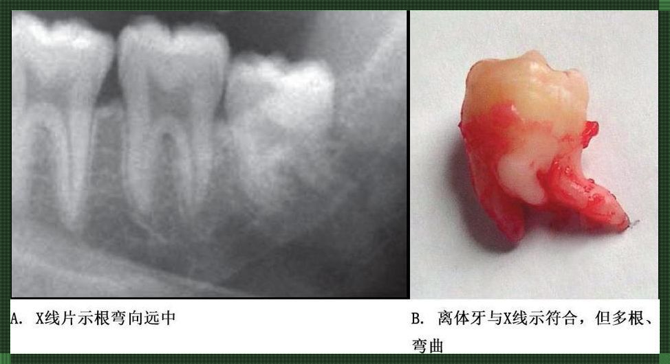 牙槽里的青春风暴：13岁pg的牙，能塞下多少梦想